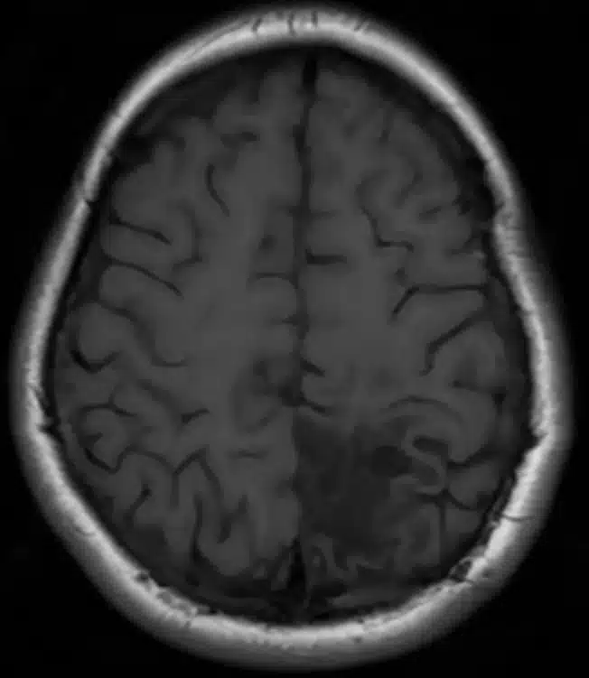 Resonancia magnética cerebral en corte axial después de una craneotomía
