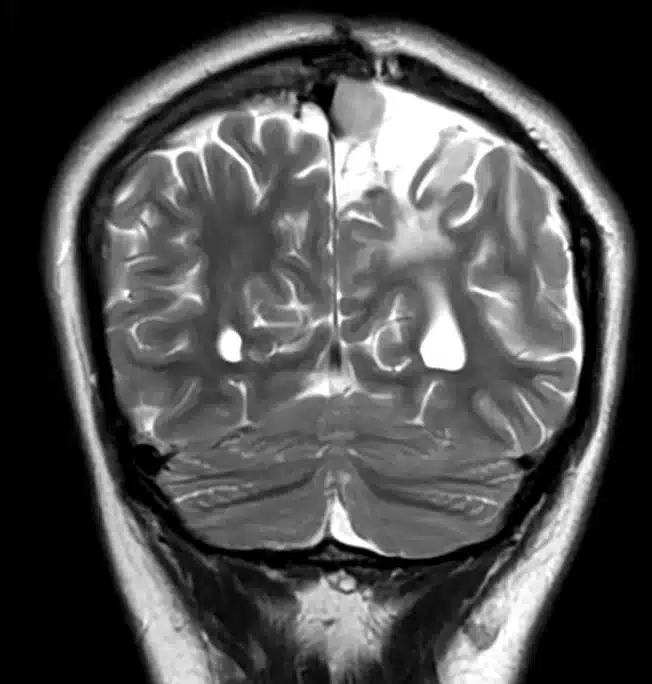 Resonancia magnética cerebral en corte coronal después de una craneotomía