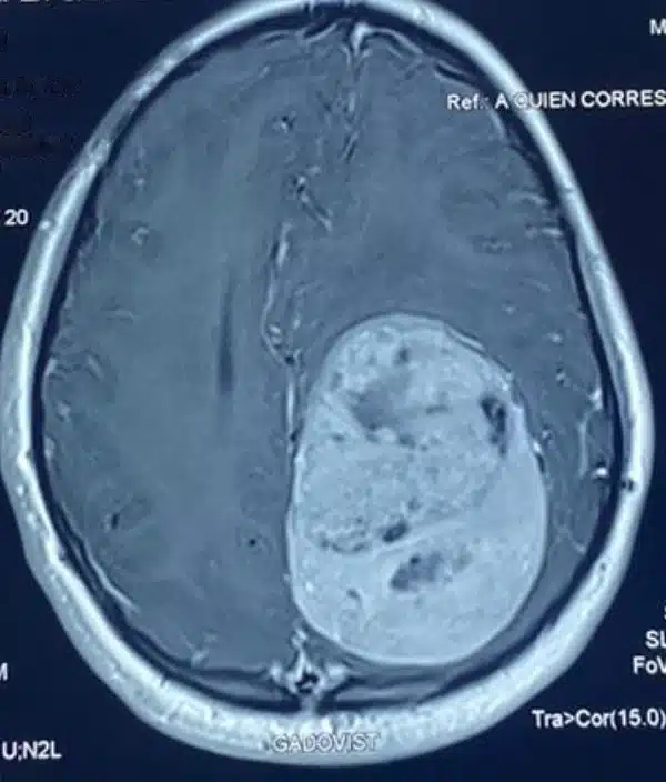 Resonancia magnética cerebral en corte axial que muestra un tumor cerebral