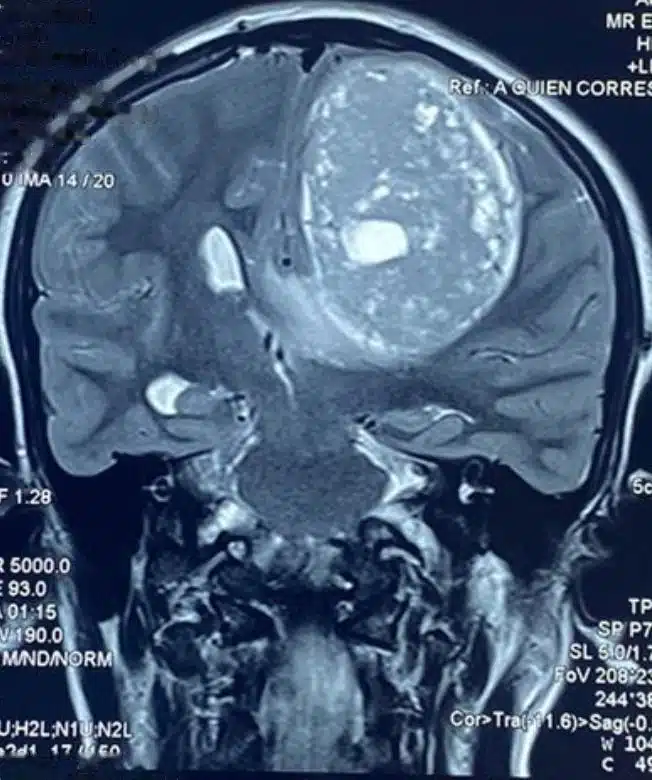Resonancia magnética cerebral en corte coronal que muestra un tumor cerebral